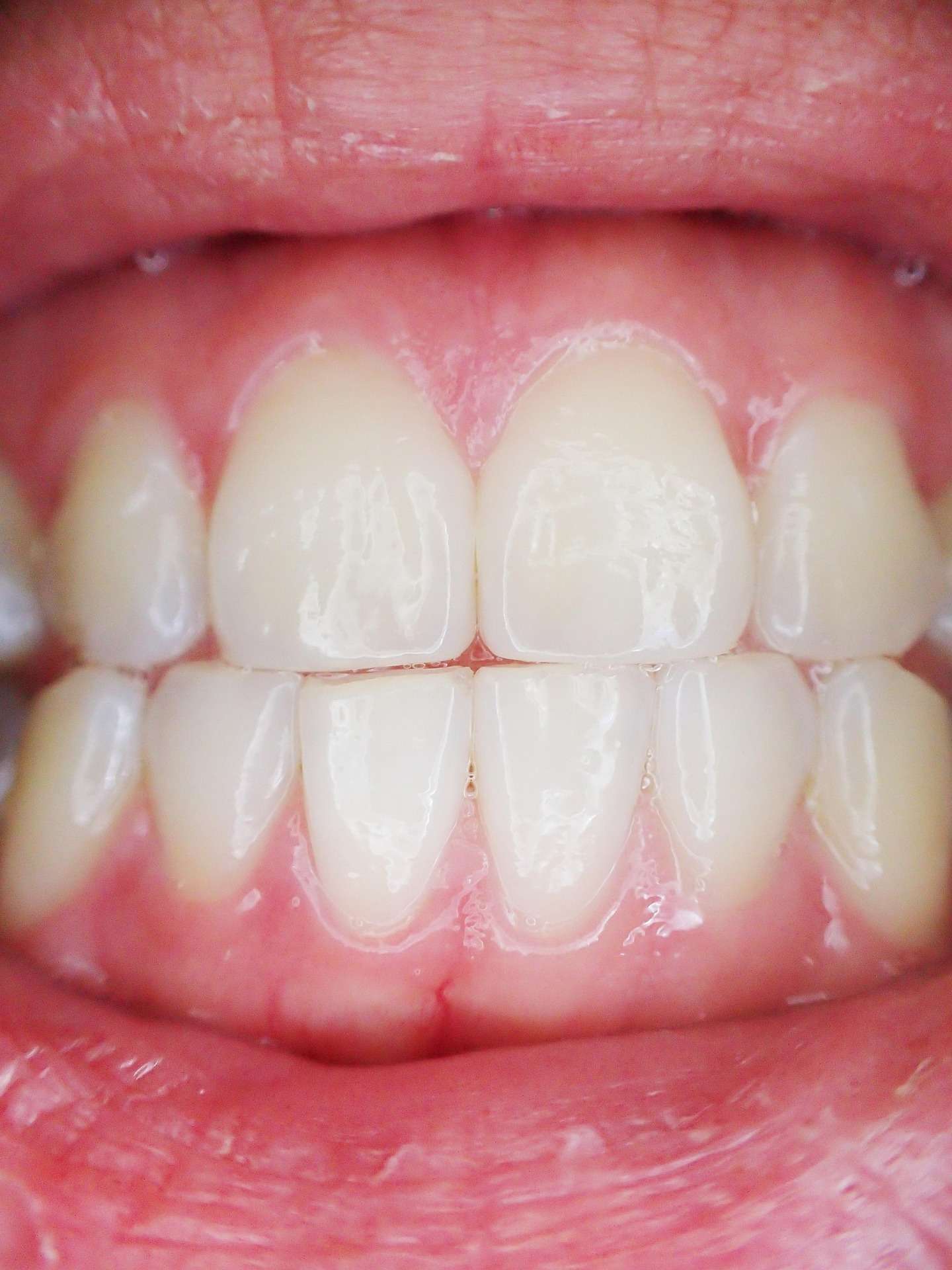 Regrow Gums Naturally