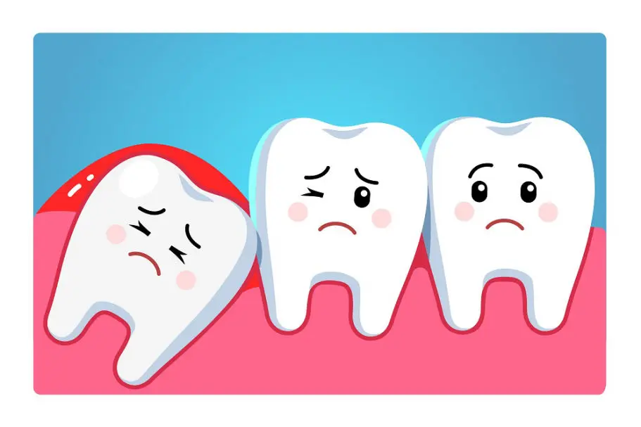 Wisdom Teeth Extractions