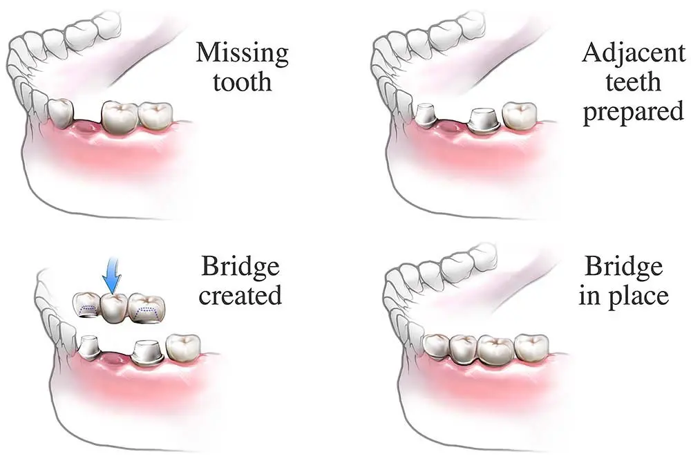 Austin Dental Bridges