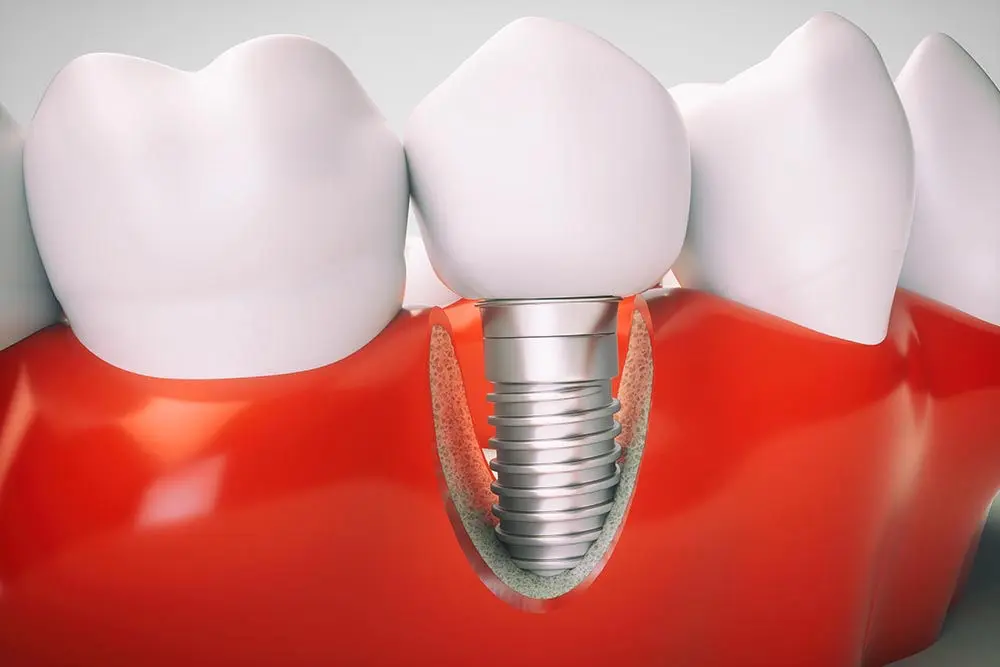 Implant Dentist