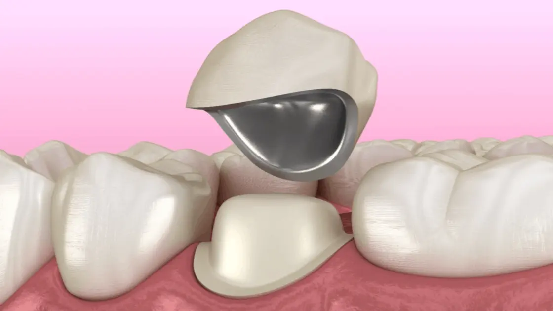 Austin Dental crowns