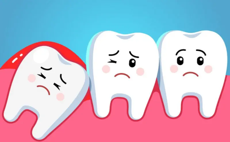 Wisdom Teeth Extractions